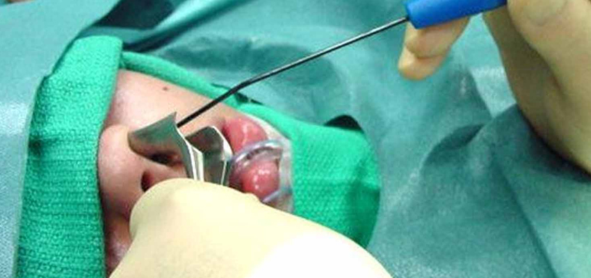 Adenoid Surgery
