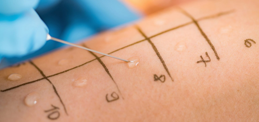 Allergy Testing