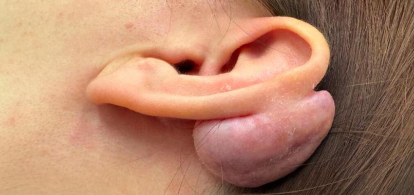 Keloid Excision