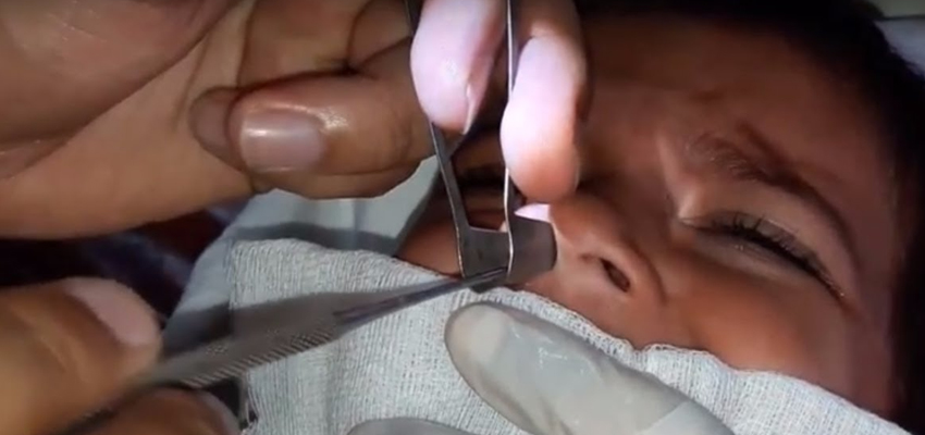 Foreign Body Removal