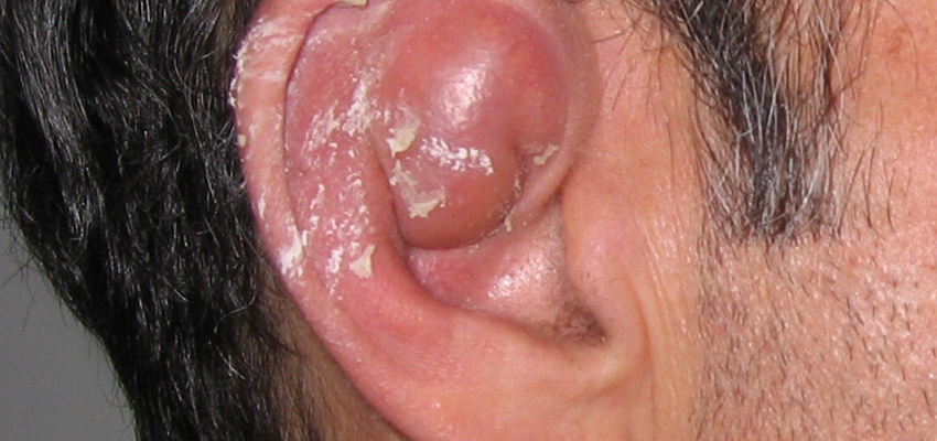Seroma Excision