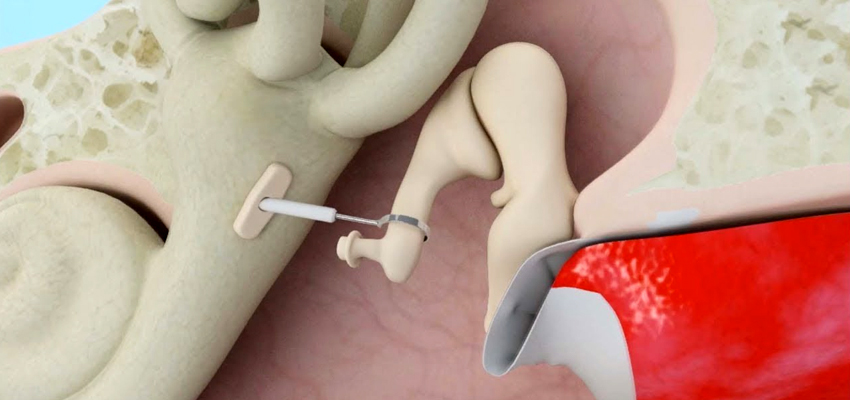 Stapes Surgery