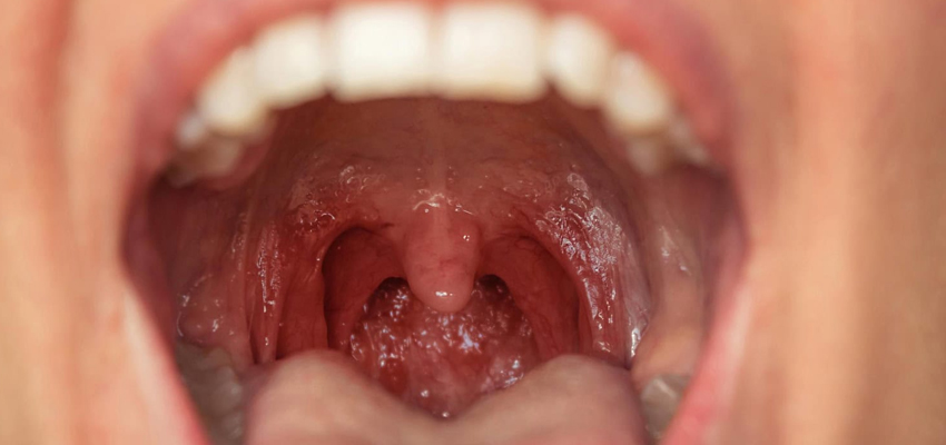 Tonsillitis