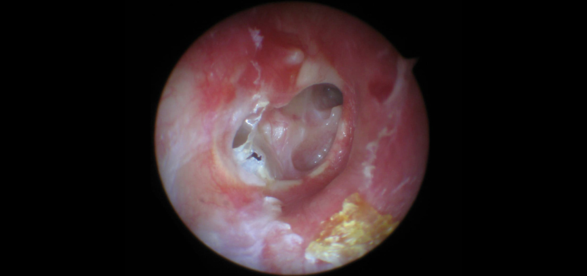 Tympanoplasty